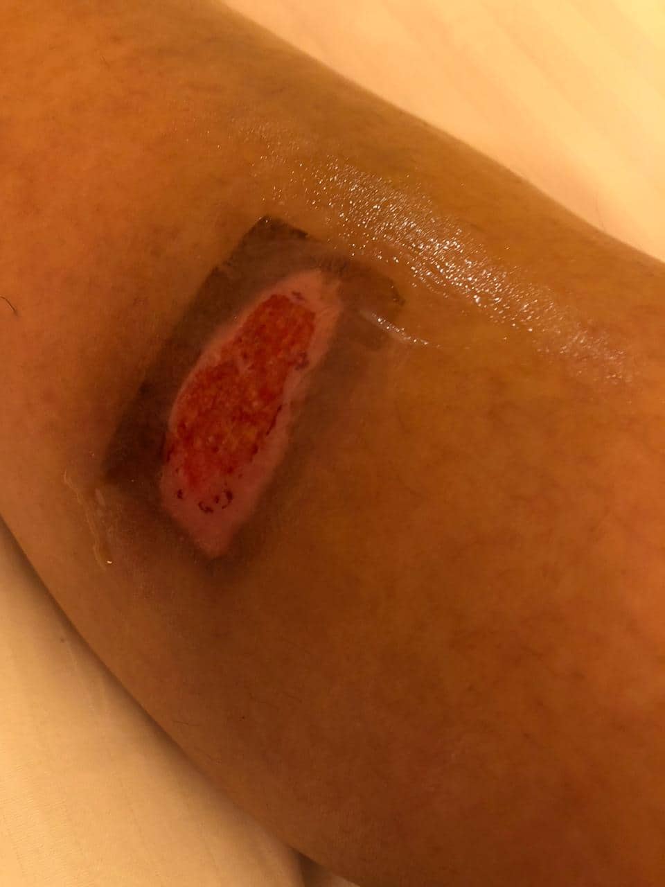 Digangana Burn