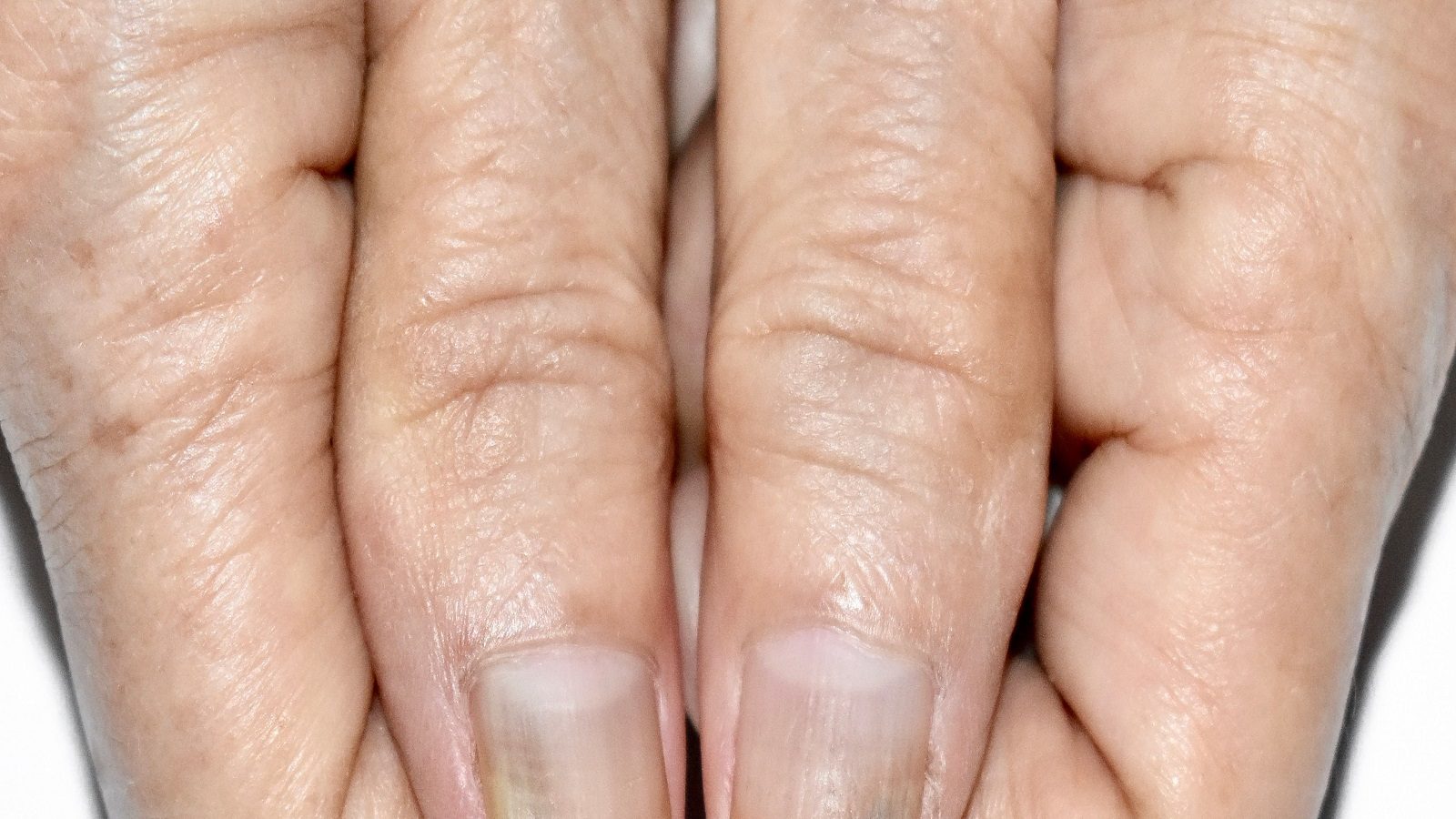 Hands of person with Raynaud's phenomenon during attack with some fingers  turned white, color change Raynaud's syndrome Raynaud disease Stock Photo -  Alamy