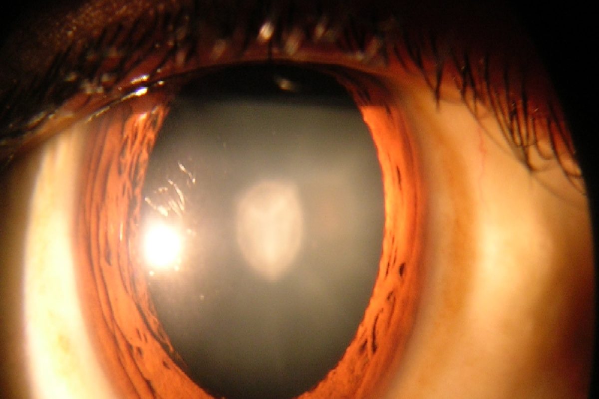 катаракта глаза симптомы фото